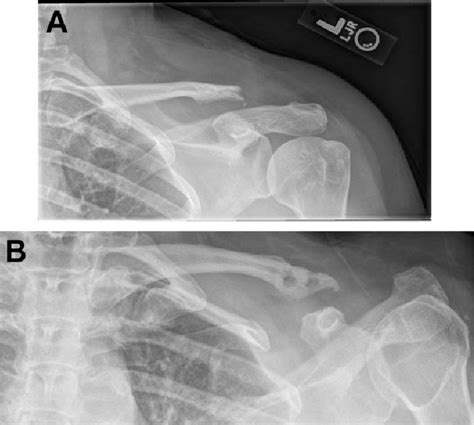 A A Patient With Recurrent Acromioclavicular Ac Joint Instability My