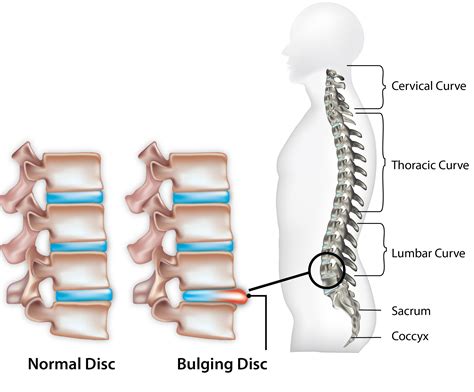 Maintain a healthy weight to reduce pressure on the discs in the back. Herniated Disc (Slipped Disc) - Causes and Symptoms ...
