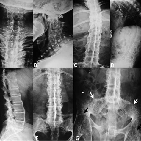 Plain Radiographs Anteroposterior And Lateral Views Of Cervical A And