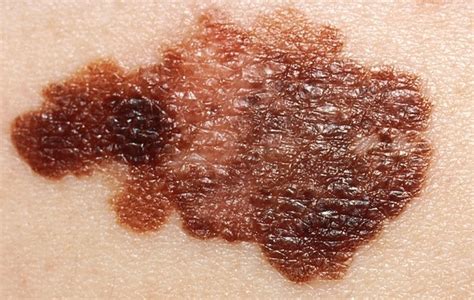 Melanoma Symptoms Causes Risk Factors Prevention And More Daily