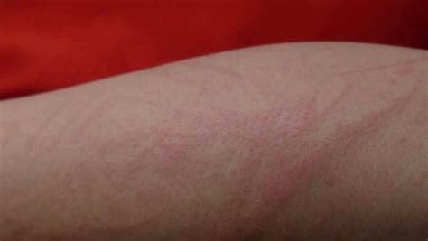 Tiene tratamiento, pero si no se le trata a tiempo, puede volverse una enfermedad crónica. Sífilis: la enfermedad cuyos síntomas pasan desapercibidos ...