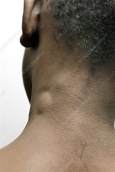 Swollen Lymph Glands Stock Image C0164828 Science Photo Library