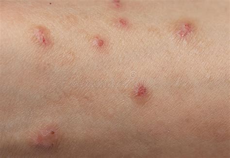 Itching Caused By Allergies Skin Women Stock Image Image Of Rash