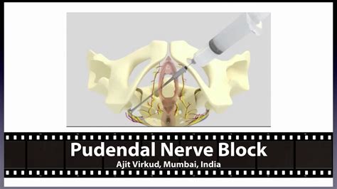 Pudendal Nerve Block About Me Tutorial