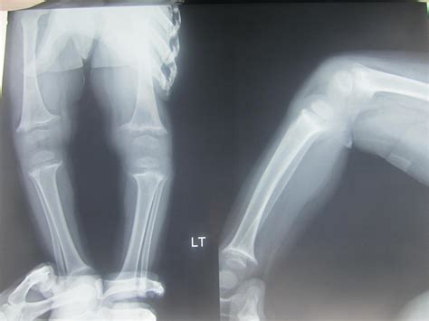 Blounts Disease Disease Infantile Orthobullets Blount Tibia Vara