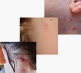 Photos of Home Remedies No See Ums