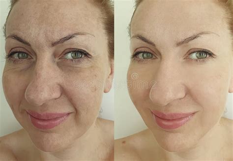 Woman Face Wrinkles Correction Before And After Revitalization Collage
