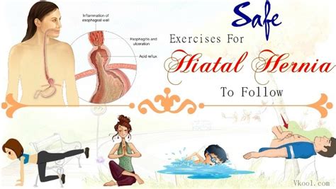 Safe Exercises For Hiatal Hernia To Follow