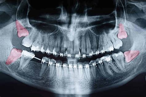 wisdom teeth extractions georgia south oral maxillofacial surgery