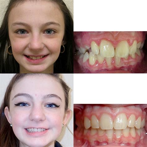 Metal Braces Before And After