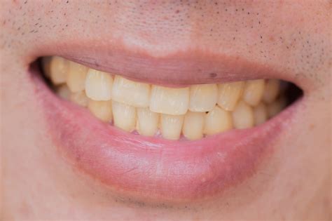 Do they stay that same shade even though you brush them thoroughly? 8 Major Causes of Yellow Stains on Teeth