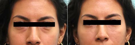 Cheeks Midface Injections Injections Photos Chevy Chase Md Patient 16311