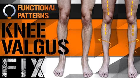 Knee Problems Correcting A Knee Valgus For The Long Term Bow Legged