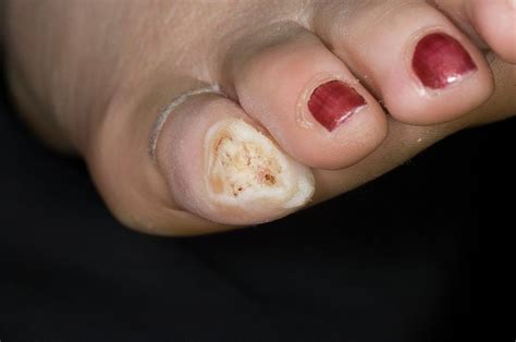 Loss Of Toenail In Fungal Infection Photograph By Dr P Marazziscience