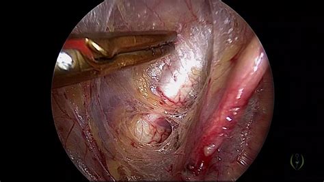 Women often feel pressure in their vaginal canal. LAPAROSCOPIC PECTOPEXY AND PLICATION OF UTEROSACRALS FOR ...