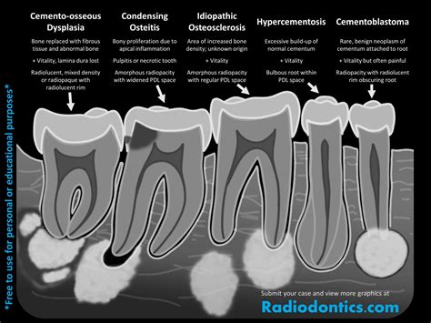 Apical Radiopacities Radiodontics