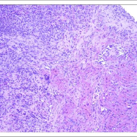 The Histopathological Appearance Of Spleen Hemangiosarcoma In A Male