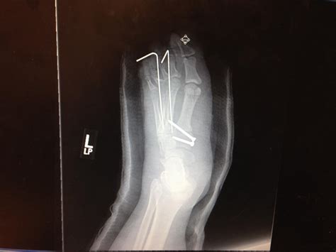 Treating An Acute Lisfranc Fracture With Orif