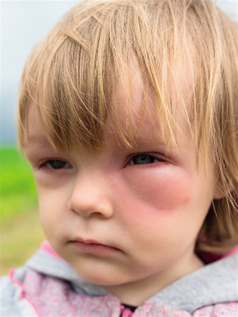 Examples include reactions to certain foods or particular insect stings. Anaphylaxis (Pediatric) Treatment | MIMS Malaysia
