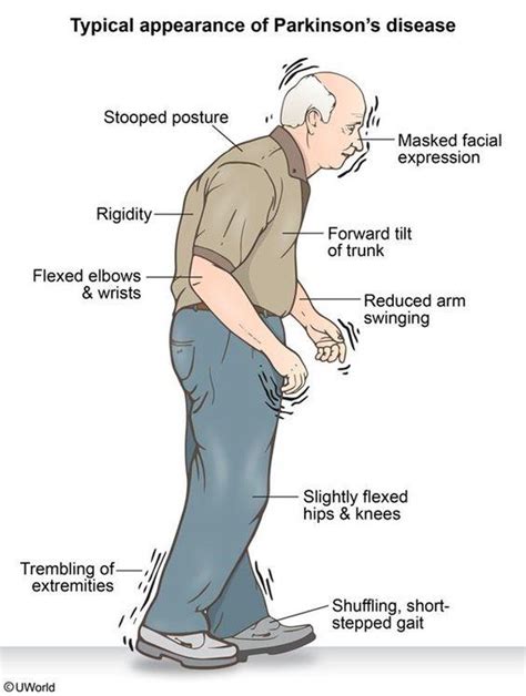 What Are The Very First Signs Of Parkinsons Disease