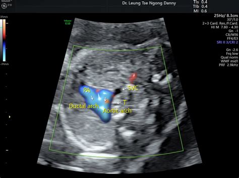 Persistent left superior vena cava - HKOG-INFO