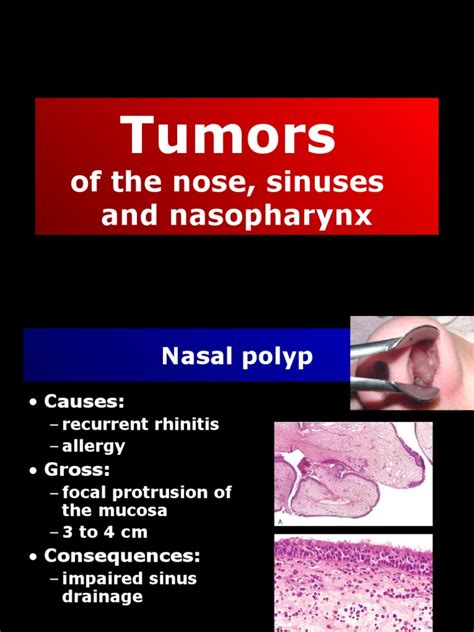 Tumors Of The Nose Sinuses And Nasopharynx Pdf Human Nose Carcinoma