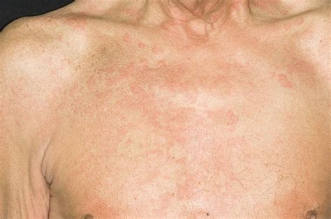 Urticaria Rash Photograph By Dr P Marazziscience Photo Library