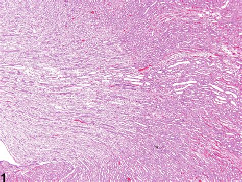 Kidney Nephropathy Obstructive Nonneoplastic Lesion Atlas