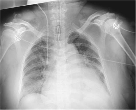 Chest Radiography Cardiomegaly And Bilateral Costophrenic Angle