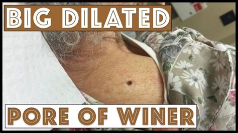 Stitching A Hole Made By A Dilated Pore Of Winer Dilated Pores