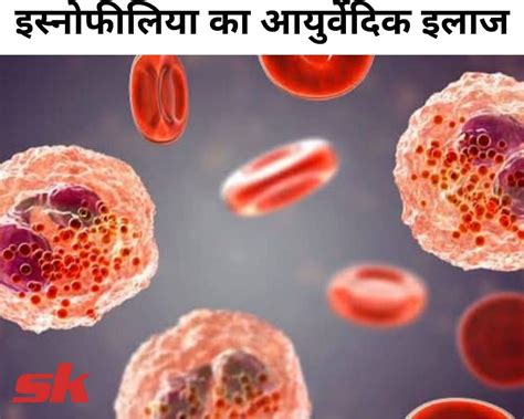Ayurvedic Treatment For Eosinophilia In Hindi इस्नोफीलिया का