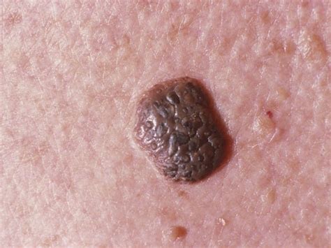Seborrheic Keratoses Everything You Need To Know Brown Spots On Skin