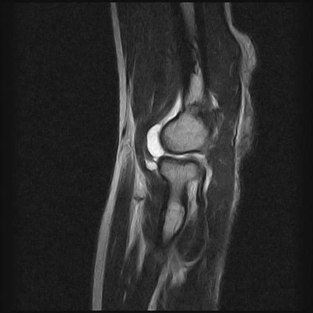 Ganglion Cyst Of The Elbow Radiology Case Radiopaedia Org