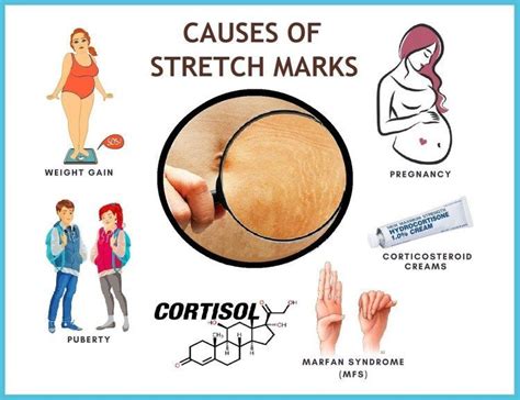 Infographic Causes Of Stretch Marks Pregnancystretchmarks Anti