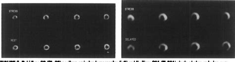 Figure From Comparison Of Rubidium Positron Emission Tomography