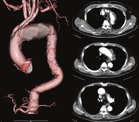 Enhanced Ct Findings Of A Thoracic Aortic Aneurysm Taa Are