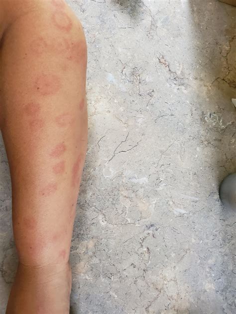 What Is This Rash Recently Dx W Lupus Lupus
