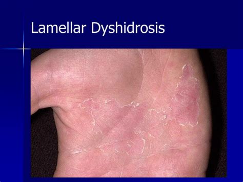 Ppt Andrews Diseases Of The Skin Chapter 10 Pg 239 253 Chapter 11