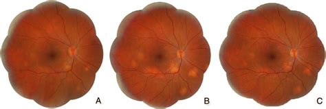 Od Fundus A Initial Visit Optic Disc Hyperemia And Edema And Several
