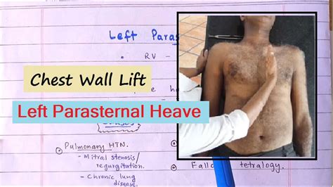 Clinical Sign Of Right Ventricular Hypertrophy Left Parasternal Heave