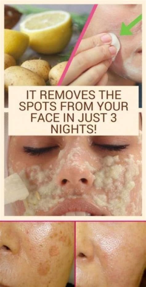 Pin By Kiara Thomas On Body Care In 2020 Brown Spots On Face Brown