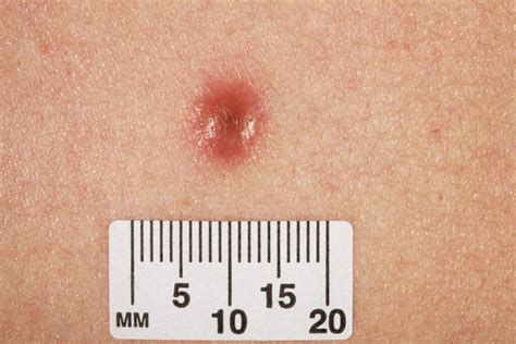 Benign Lesion Skin Tags Warts Moles Dermatofibroma Refhelp