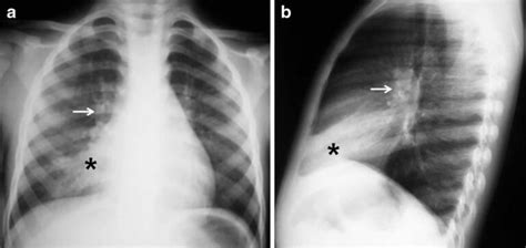 Ghon Complex Ghon Focus Definition Chest X Ray And Causes