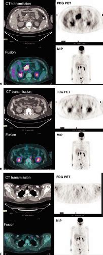 Pet And Petct Of Malignant Melanoma Radiology Key