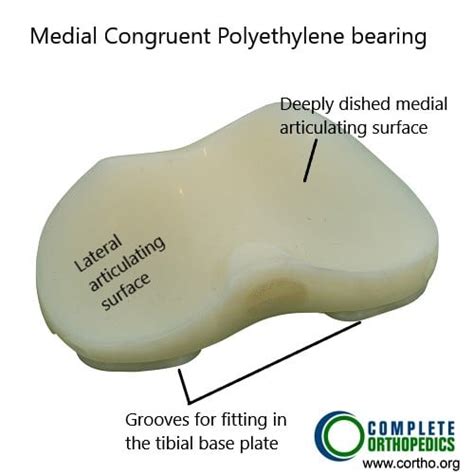 Knee Arthroplasty Implants Complete Orthopedics Multiple Ny Locations