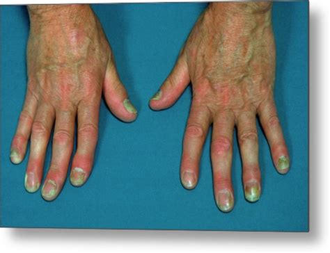 Psoriasis Affecting The Fingers Photograph By James Stevensonscience
