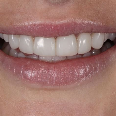 Teeth composite bonding: everything to know, from cost to care