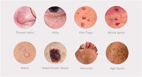 Wart And Skin Tag Removal In Bolton Evolve Private Aesthetics Clinic
