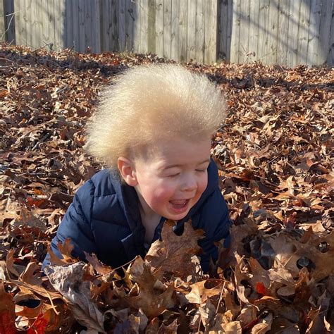 A Toddler Who Was Diagnosed With Rare “uncombable Hair Syndrome