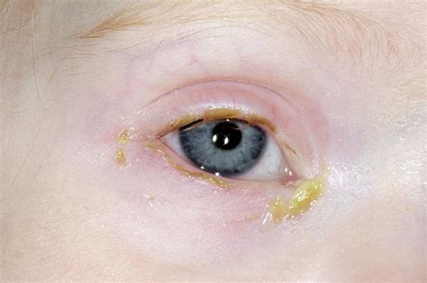 Acute Bacterial Conjunctivitis Photograph By Dr P Marazziscience